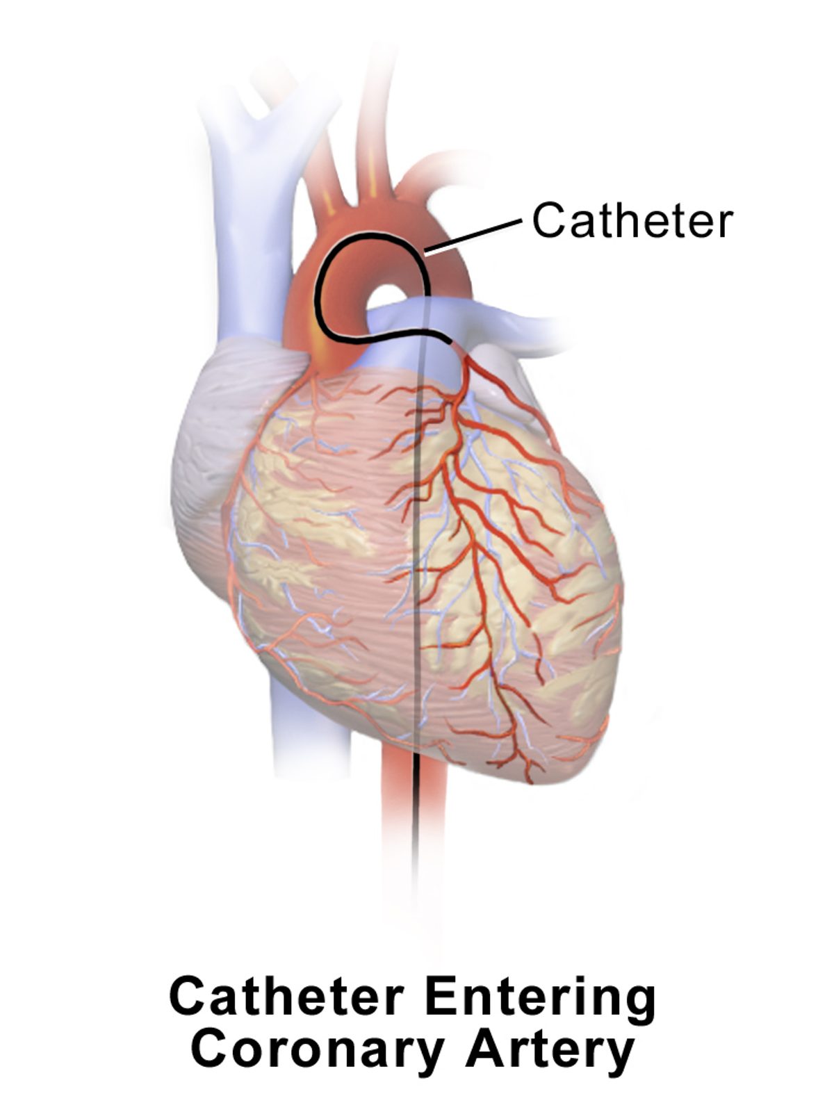 Rubber Catheter (Nelaton Type)